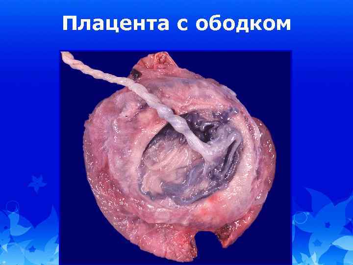 Плацента с ободком 