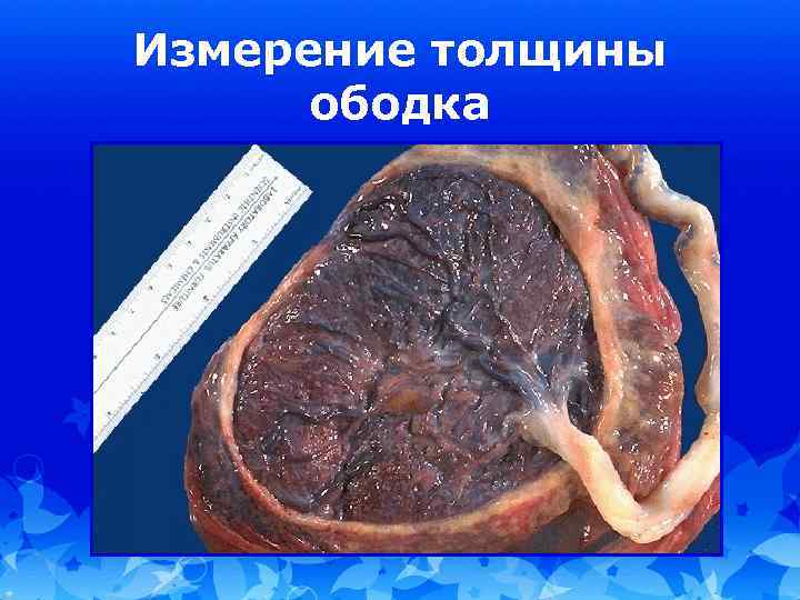 Измерение толщины ободка 