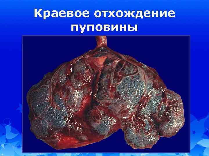 Краевое отхождение пуповины 