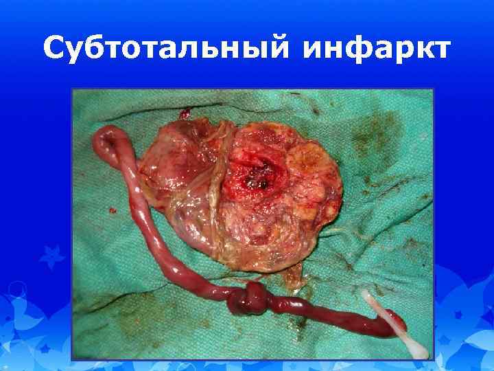 Субтотальный инфаркт 