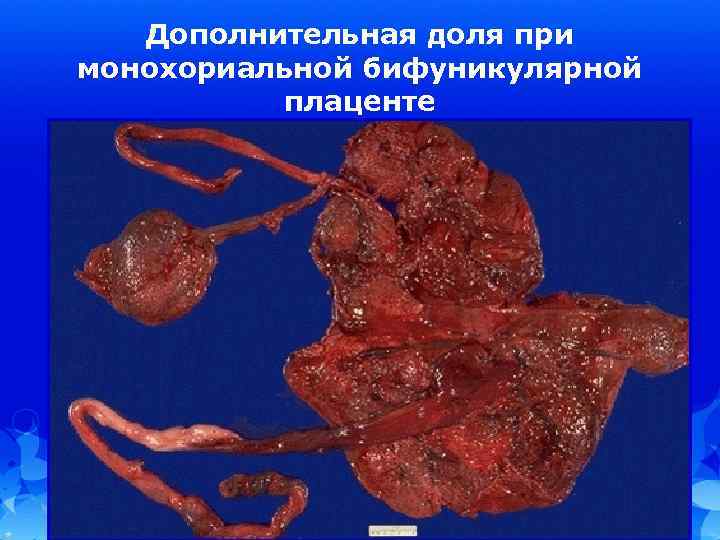 Дополнительная доля при монохориальной бифуникулярной плаценте 