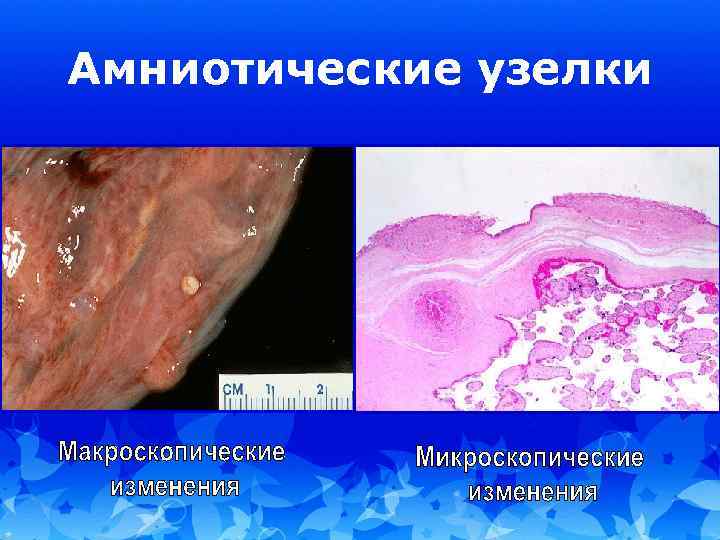 Амниотические узелки 