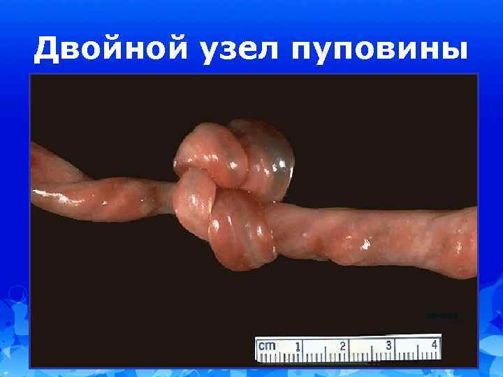 Двойной узел пуповины 
