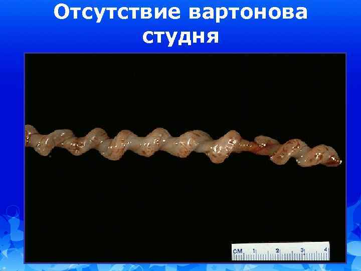 Отсутствие вартонова студня 