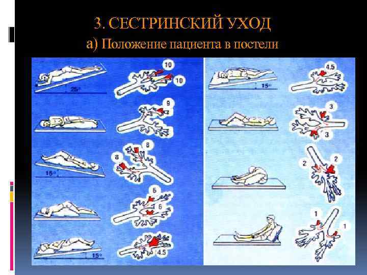 3. СЕСТРИНСКИЙ УХОД а) Положение пациента в постели 