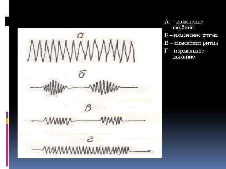 А – изменение глубины Б – изменение ритма В – изменение ритма Г –