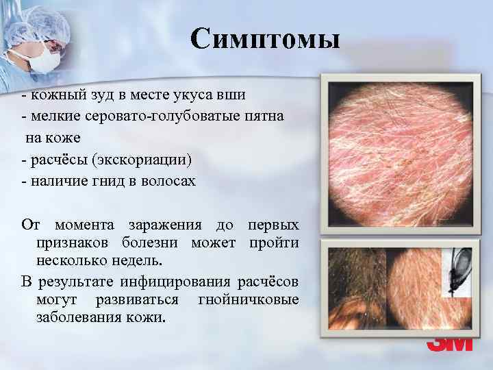 Симптомы - кожный зуд в месте укуса вши - мелкие серовато-голубоватые пятна на коже