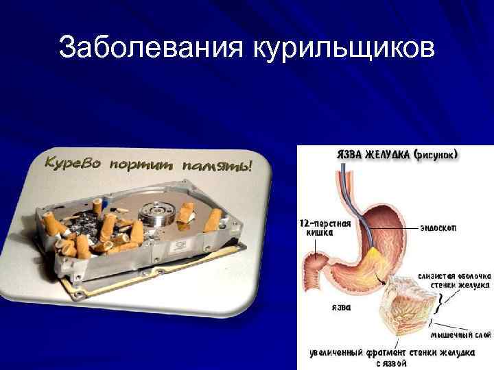 Заболевания курильщиков 