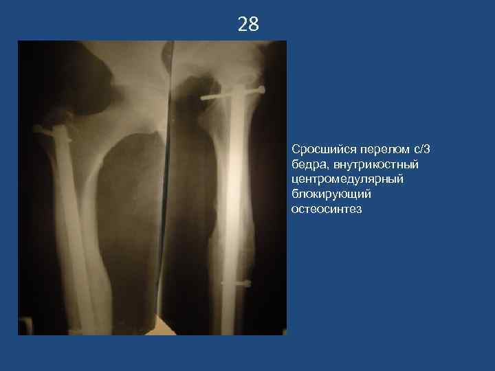 28 Сросшийся перелом с/3 бедра, внутрикостный центромедулярный блокирующий остеосинтез 