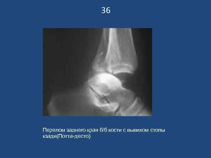 36 Перелом заднего края б/б кости с вывихом стопы кзади(Потта-десто) 