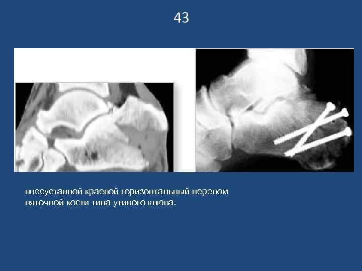 43 внесуставной краевой горизонтальный перелом пяточной кости типа утиного клюва. 