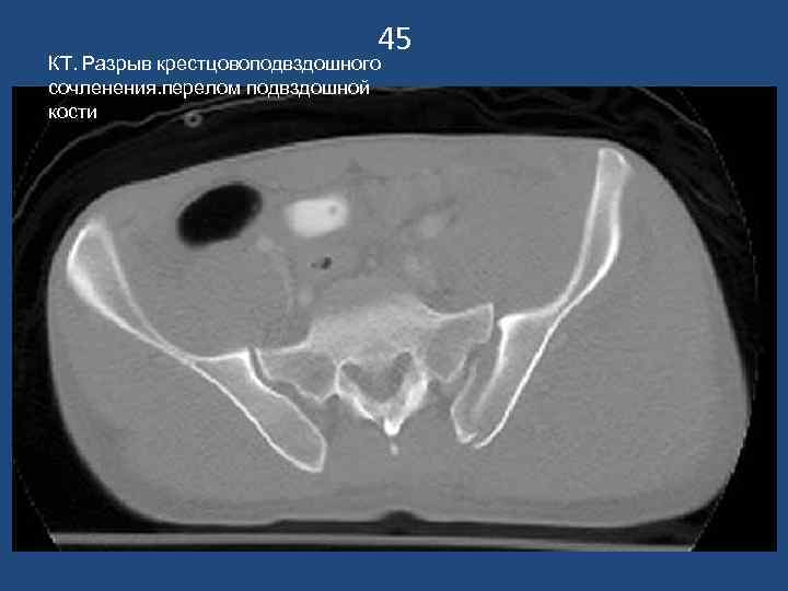 45 КТ. Разрыв крестцовоподвздошного сочленения. перелом подвздошной кости 
