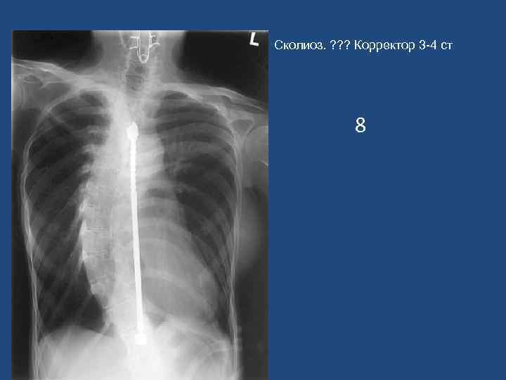 Сколиоз. ? ? ? Корректор 3 -4 ст 8 