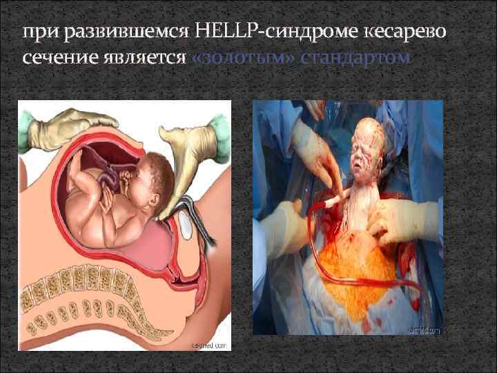 при развившемся HELLP-синдроме кесарево сечение является «золотым» стандартом 