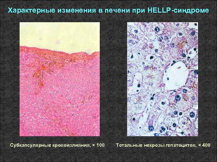 Характерные изменения в печени при HELLP-синдроме Субкапсулярные кровоизлияния, × 100 Тотальные некрозы гепатоцитов, ×