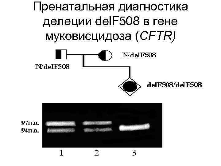 Пренатальная диагностика делеции del. F 508 в гене муковисцидоза (CFTR) 