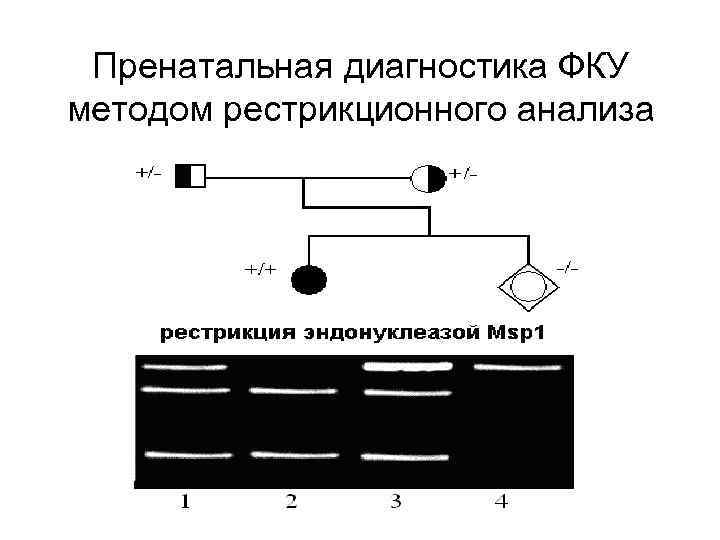 Пренатальная диагностика ФКУ методом рестрикционного анализа 