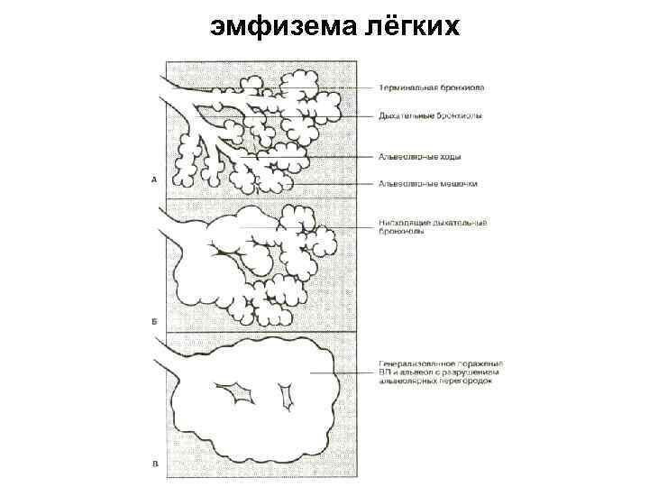 эмфизема лёгких 