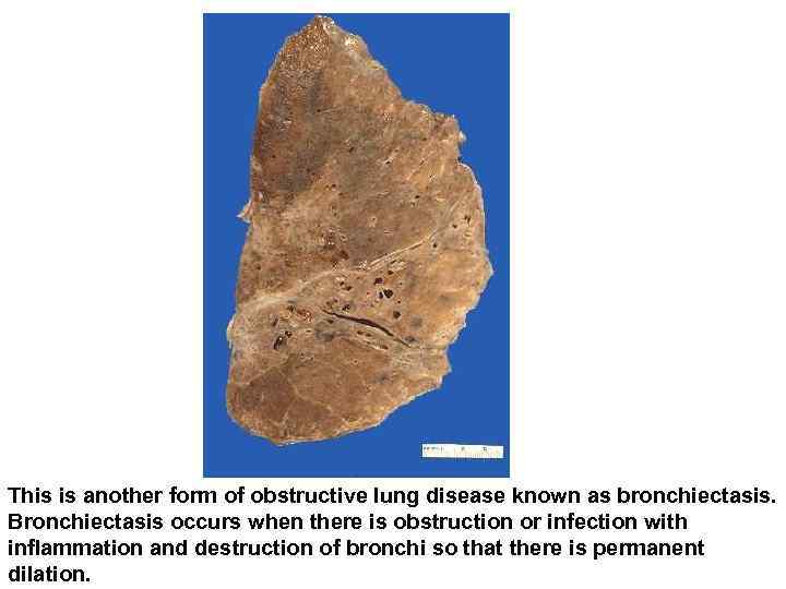 This is another form of obstructive lung disease known as bronchiectasis. Bronchiectasis occurs when