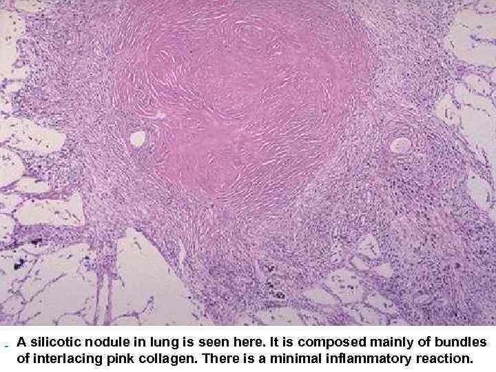  A silicotic nodule in lung is seen here. It is composed mainly of