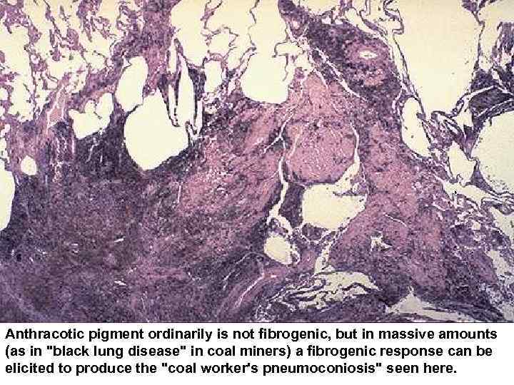 Anthracotic pigment ordinarily is not fibrogenic, but in massive amounts (as in 