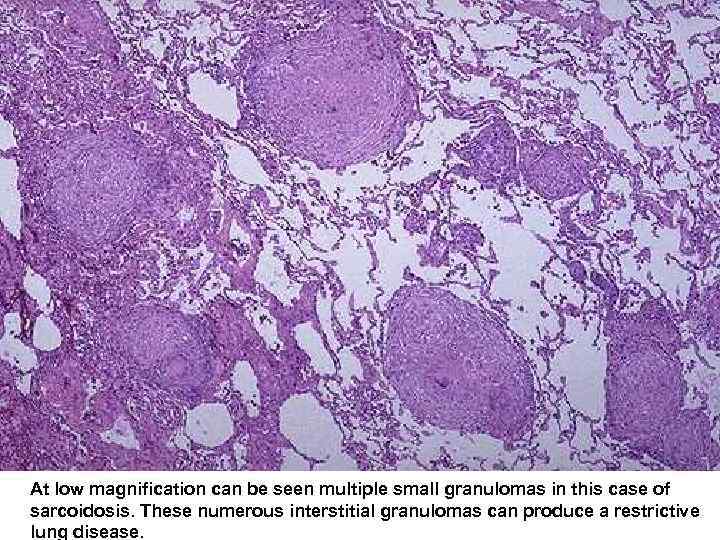  At low magnification can be seen multiple small granulomas in this case of