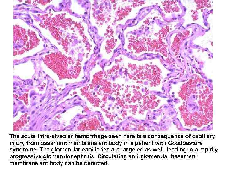  The acute intra-alveolar hemorrhage seen here is a consequence of capillary injury from