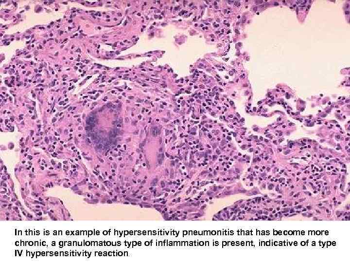  In this is an example of hypersensitivity pneumonitis that has become more chronic,