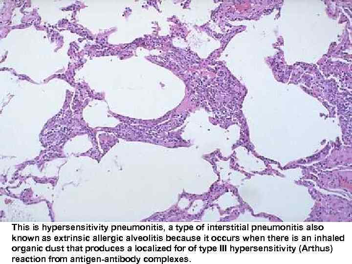 This is hypersensitivity pneumonitis, a type of interstitial pneumonitis also known as extrinsic allergic