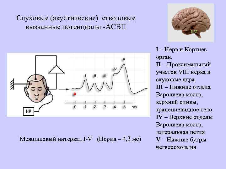 Слуховые (акустические) стволовые вызванные потенциалы -АСВП Межпиковый интервал I-V (Норма – 4, 3 мс)