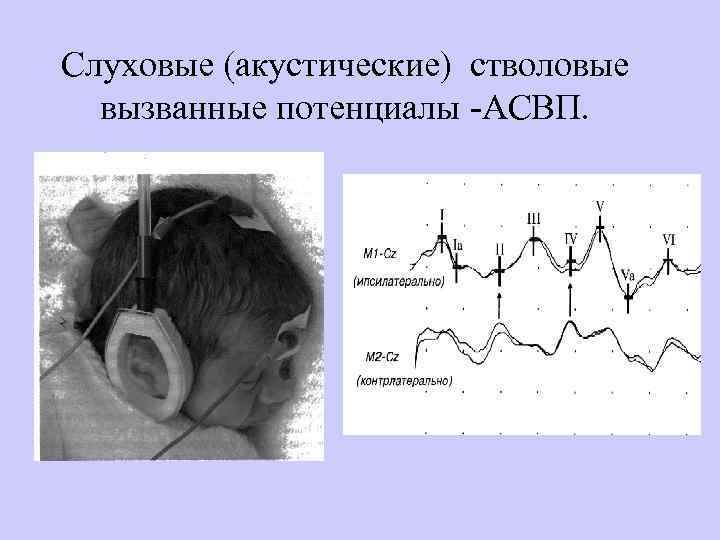 Слуховые (акустические) стволовые вызванные потенциалы -АСВП. 