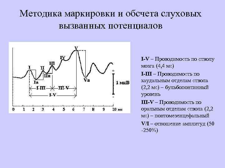 Методика маркировки и обсчета слуховых вызванных потенциалов I-V – Проводимость по стволу мозга (4,