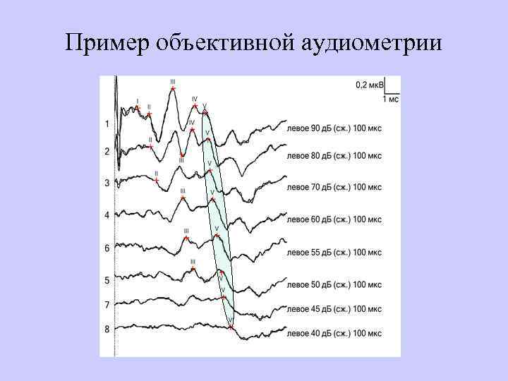 Пример объективной аудиометрии 