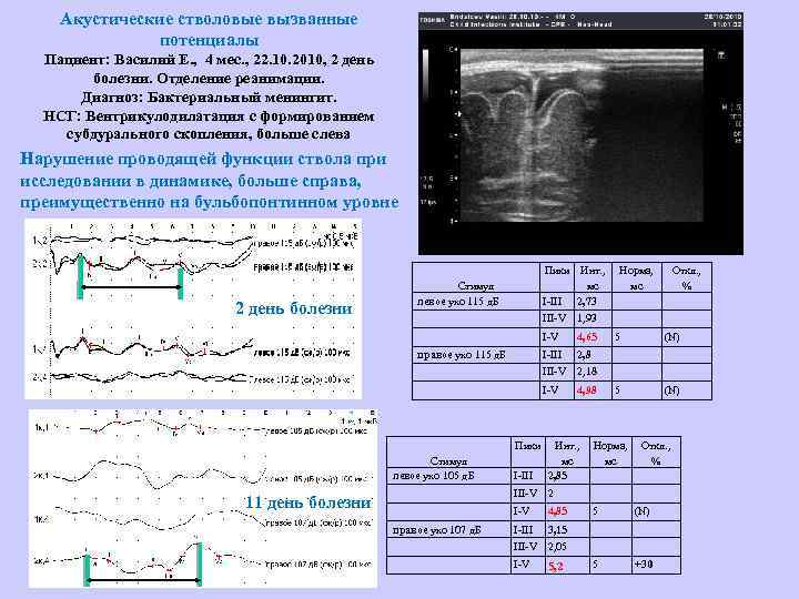 Акустические стволовые вызванные потенциалы Пациент: Василий Е. , 4 мес. , 22. 10. 2010,