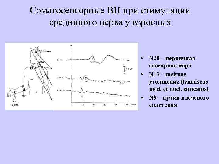 Соматосенсорные ВП при стимуляции срединного нерва у взрослых • N 20 – первичная сенсорная