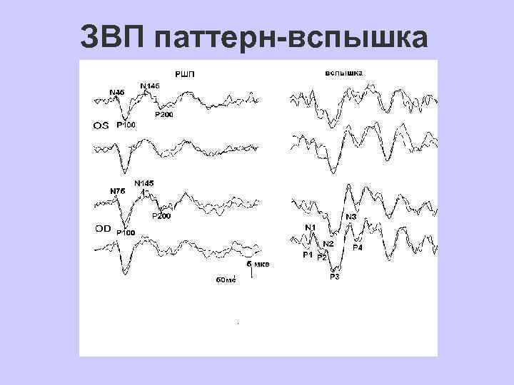 ЗВП паттерн-вспышка 