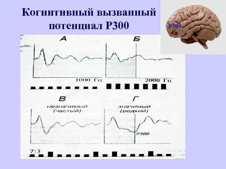 Когнитивный вызванный потенциал Р 300 P 300 