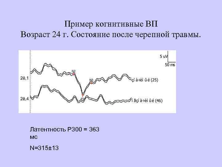 Пример когнитивные ВП Возраст 24 г. Состояние после черепной травмы. Латентность Р 300 =