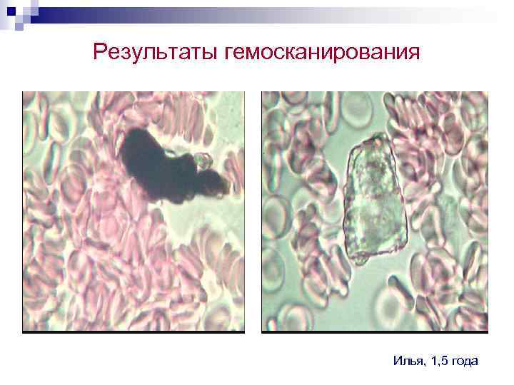 Результаты гемосканирования Илья, 1, 5 года 