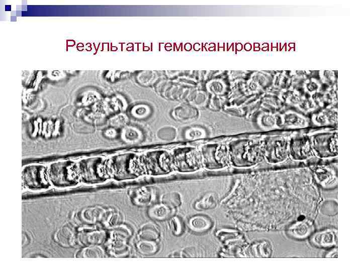 Результаты гемосканирования 