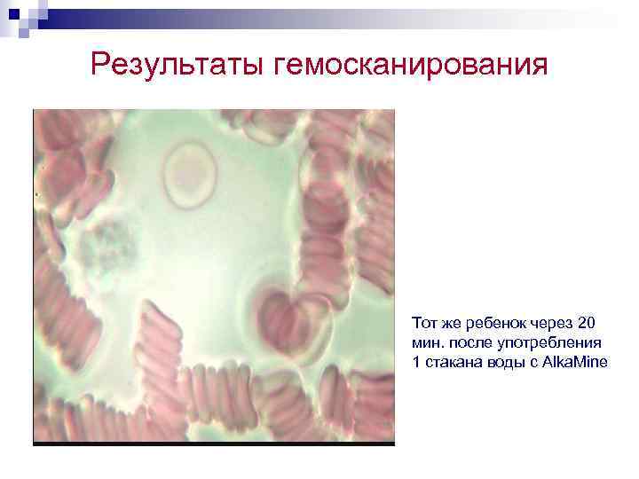 Результаты гемосканирования Тот же ребенок через 20 мин. после употребления 1 стакана воды с