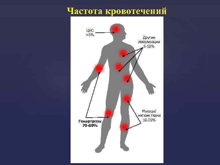 Частота кровотечений ЦНС >5% Гемартрозы 70 -80% Другие локализации 5 -10% Мышцы/ мягкие ткани