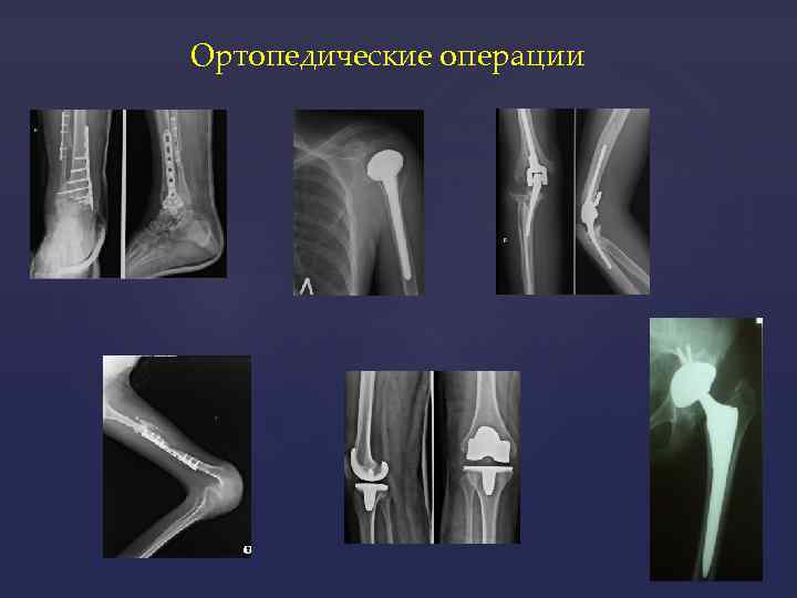 Ортопедические операции 