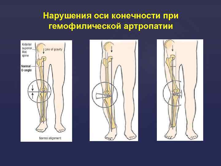 Нарушения оси конечности при гемофилической артропатии 