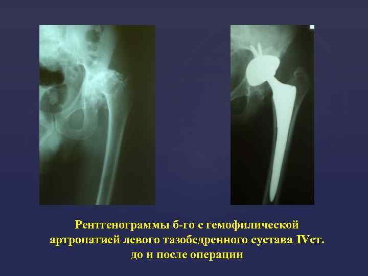 Рентгенограммы б-го с гемофилической артропатией левого тазобедренного сустава IVст. до и после операции 
