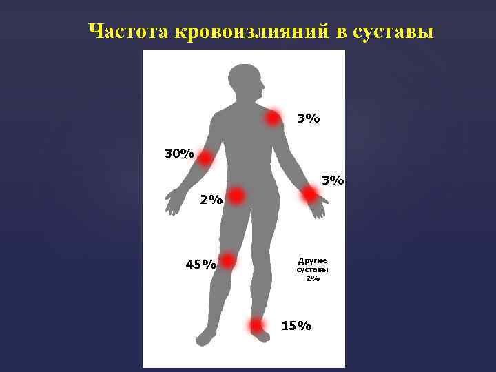 Частота кровоизлияний в суставы 3% 30% 3% 2% 45% Другие суставы 2% 15% 