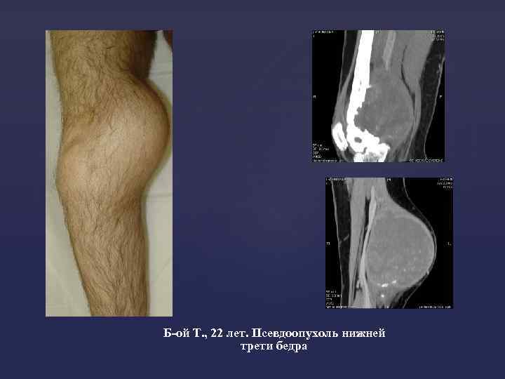 Б-ой Т. , 22 лет. Псевдоопухоль нижней трети бедра 