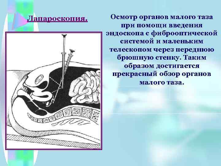 Лапароскопия. Осмотр органов малого таза при помощи введения эндоскопа с фиброоптической системой и маленьким