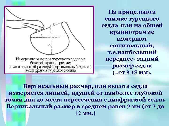 На прицельном снимке турецкого седла или на общей краниограмме измеряют саггитальный, т. е. наибольший