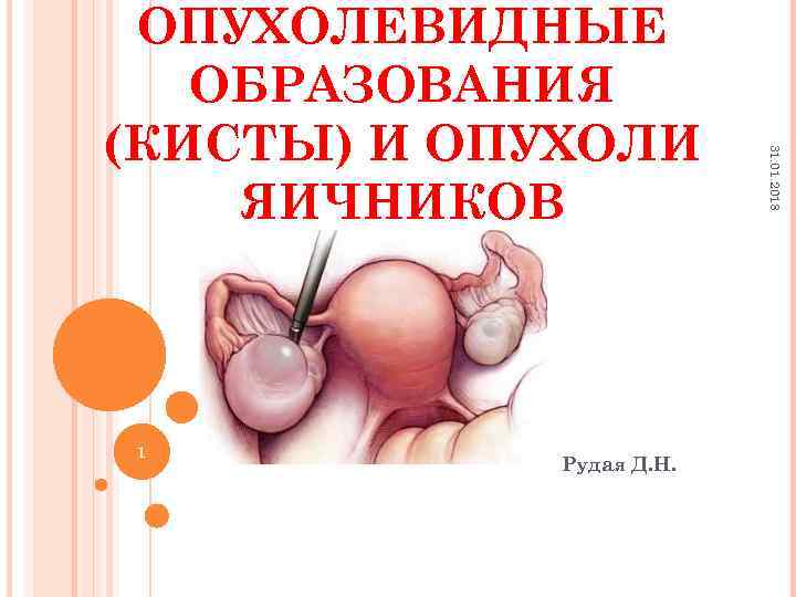 1 Рудая Д. Н. 31. 01. 2018 ОПУХОЛЕВИДНЫЕ ОБРАЗОВАНИЯ (КИСТЫ) И ОПУХОЛИ ЯИЧНИКОВ 